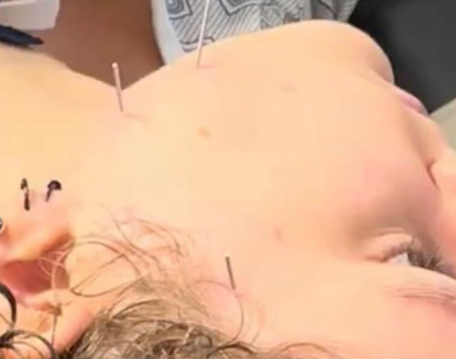 Dry Needling Bellevue WA